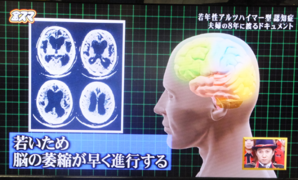 認知症02