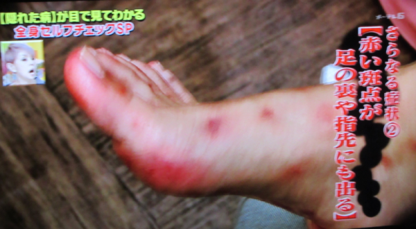 足に赤い斑点03