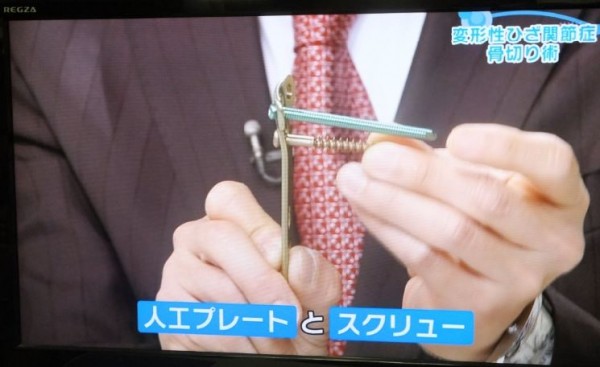 人工プレートとスクリュー