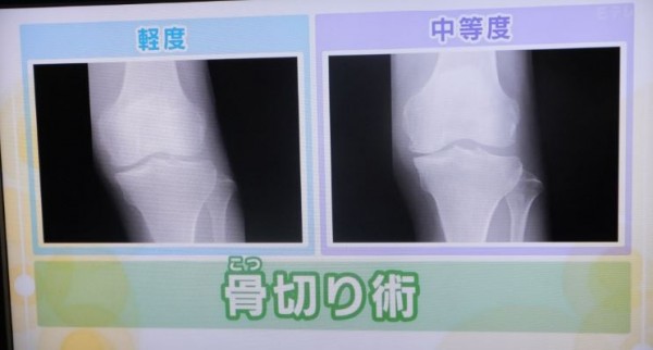 骨切り術1