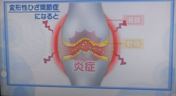 変形性膝関節症とは01.